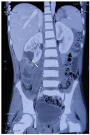 Image result for Perinephric Abscess