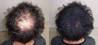 The new hair follicles are then attached to the bald patches to reclaim the lost hairline. How To Cover Bald Spots Naturally For Men And Women