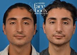 Male Rhinoplasty In 2020 Rhinoplasty Rhinoplasty Surgeon Body