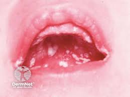 Image result for oral thrush symptoms roof of the mouth