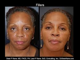 This African American Woman From Baltimore Was Unhappy With Her Lower Lids She Felt She Had Dark Circles And B Skin Dryness Injectables Fillers Erase Wrinkles