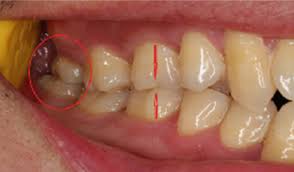 Ben affleck teeth got attention of people in movie armageddon. How Much Does It Cost To Remove Your Wisdom Tooth