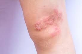 Image result for psoriasis