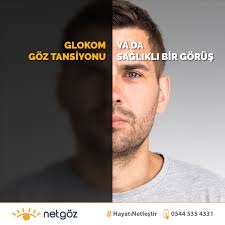 Glokomun Gorusunuzu Calmasina Izin Vermeyin Halk Arasinda Goz Tansiyonu Olarak Bilinen Glokom Fark Edilmesi Oldukca Zor Olan Ve Kalici G Tansiyon Gozler Jelsa