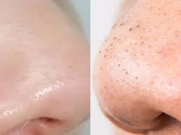 Ia mudah, tak perlu semai dan alih anak benih. Kenapa Kita Kena Buang Blackhead Dan Whitehead Remaja
