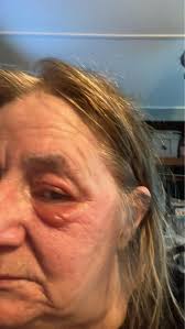 I think I rubbed my eye when I had resin