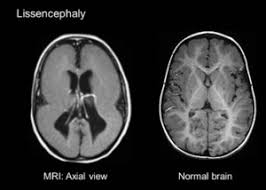 Agyria (complete lissencephaly) presents with smooth brain and is identified by figure eight configuration. Human Relevant Model Of Rare Genetic Disorder Offers Insights Into Brain Development