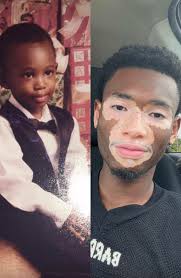 Aceptando mi vitiligo: un viaje de amor propio