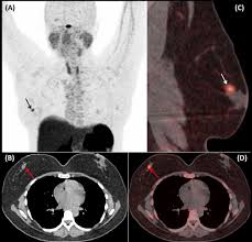 Each has its own strengths. Breast Fibroadenoma With Increased Activity On 68ga Dotatate Pet Ct Abstract Europe Pmc
