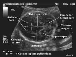 Fetal Brain Obstetric Ultrasound Ultrasound Technician Medical Ultrasound