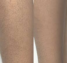 Does laser hair removal permanently remove hair? Pulse Laser Clinic Hair Removal On Dark Skin Tones Abc Lasers