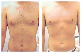 Six laser hair removals for a small, medium, or large area at advanced laser clinics oakbrook (up to 93% off). Invest In Laser Hair Removal Save Big Radiance Skincare Laser Medspa Wheaton Il