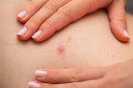 Image result for folliculitis symptoms