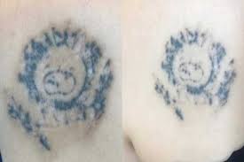 Ultimately, the removal of a tattoo takes three different forms: Tattoo Removal Hypopigmentation And Hyperpigmentation Removery