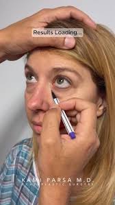 This beautiful patient complained of looking tired due to puffy lower eye  bags. We performed our signature #TrifectaLift to rejuvenate her eyes  without looking “overdone”., ✍️Trifecta Lift consists ...