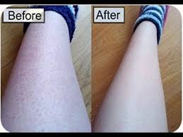 التخلص من الشعر تحت الجلد للساقين Ingrown Hair Remedies Ingrown Hair Strawberry Legs