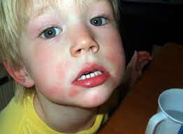 Allergic To Tomato Know Signs And Treatments Med Health Net
