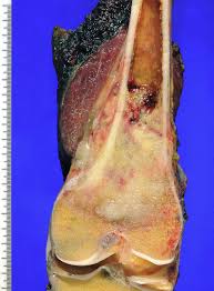 Image result for Osteosarcoma