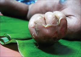 Staphylococcal Scalded Skin Syndrome Wikipedia