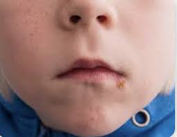 Image result for yellow scabs on the face in children