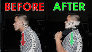 In 2011 i had ct of spine. Restore Your Neck Posture Curve Cervical Lordosis Youtube