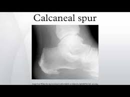 Let me show you some important words which have multiple meaning as per the context. Calcaneal Spur Youtube