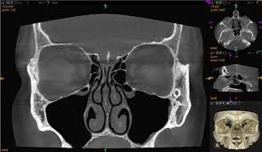 Image result for Sinus CT