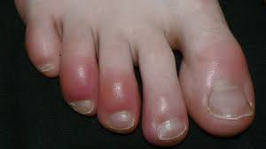 Tiny black skin spots are common, especially for young adults. Coronavirus Five Skin Conditions Linked To Covid 19 Identified Study Finds World News Sky News