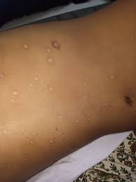25 years' experience with the biken oka strain varicella vaccine: Rare Case Of Post Varicella Membranoproliferative Glomerulonephritis Presenting With Massive Proteinuria Bmj Case Reports