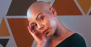 Image result for Alopecia