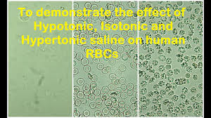 Check spelling or type a new query. Rbcs In Hypotonic Isotonic And Hypertonic Solution Practical Lab Youtube