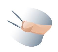 Clínica privada fimosis: Cirugía, precios y resultados