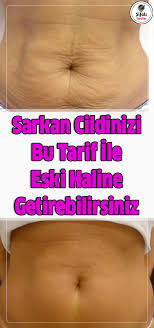 Sarkan Cildinizi Bu Tarif Ile Eski Haline Getirebilirsiniz Dogum Yapan Kadinlar Veya Kisa Surede Cok Fazla Kilo Veren Cilt Bakimi Cilt Bakimi Tuyolari Saglik