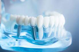 Dental Implants for 20, 30, 40 & 50 Year Old's – All Ages