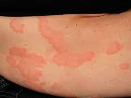 Image result for allergy rash on the legs