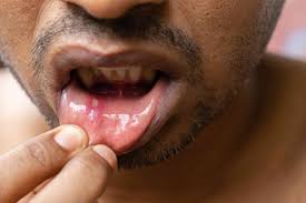 Image result for Canker sores symptoms roof of the mouth