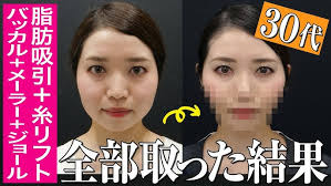 Liposuction + Thread Lift] Get a super slimmer face in just one week!  Downtime report & proper m...