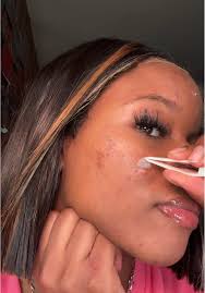 CHEWED okay ? 😂 #acnejourney #skintok #satisfying #skintok  #pimplepatchremoval