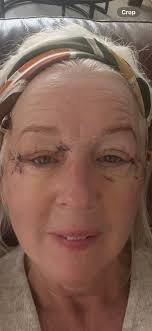 Just over a week I had upper and lower Blepharoplasty uk no pain, however a  lot of tightness eased slightly after the sutures where removed. Still  feeling tired. Swelling more so at
