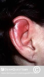 Image result for Relapsing Polychondritis