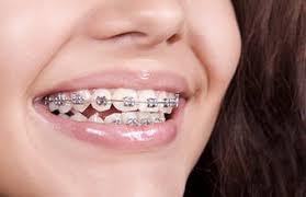 Our experts reviewed the aids that offer the best fit and compression. How To Relieve Pain Caused By Braces Theforbiz