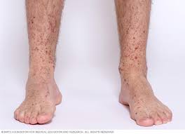 Appearance of purpura acutely after sun exposure is rare. Henoch Schonlein Purpura Symptoms And Causes Mayo Clinic