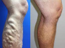 Varicose Veins Laser Treatment Peter Brukasz Md Addison Il Palos Hills Il