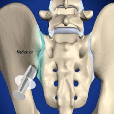 Image result for Joint Injection