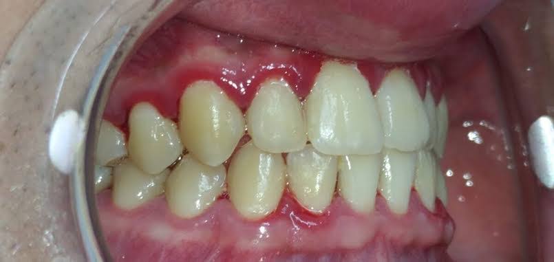 BLEEDING GUMS product image