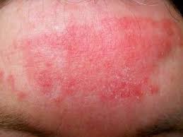 Merve Den Guzellik Sirlari Seboreik Dermatit Nedir Guzellik Sirlari Guzellik