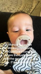 Marcus Gunn Story Pictures