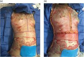 Public users are able to search the site and view the abstracts for each book and chapter without a subscription. Escharotomy In Burns Chapter 48 Atlas Of Surgical Techniques In Trauma