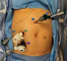 Liver resection is surgery to remove an area of your liver. Surgical Resection In Hcc Intechopen