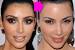 Before And After Laser Hair Removal Face